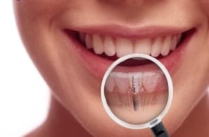 Implantes Dentale en Cúcuta - Colombia